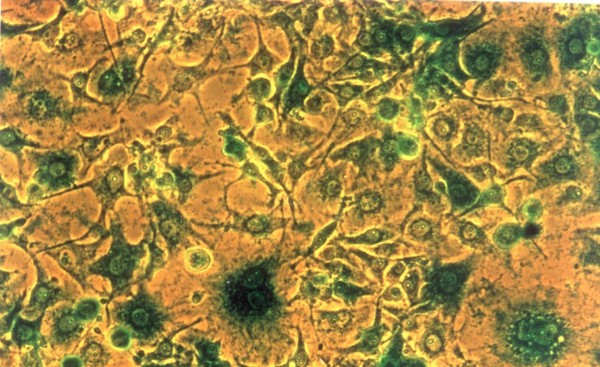 Клетки линии U373, зараженные рекомбинантным человеческим аденовирусом V типа, несущего LacZ-ген кишечной палочки E.coli, и выявление ферментативной активности β-галактозидазы в этих клетках