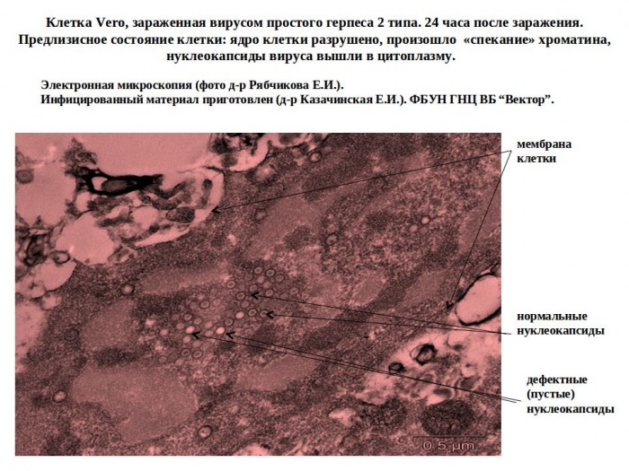 Клетки Vero, зараженные вирусом простого герпеса 2 типа